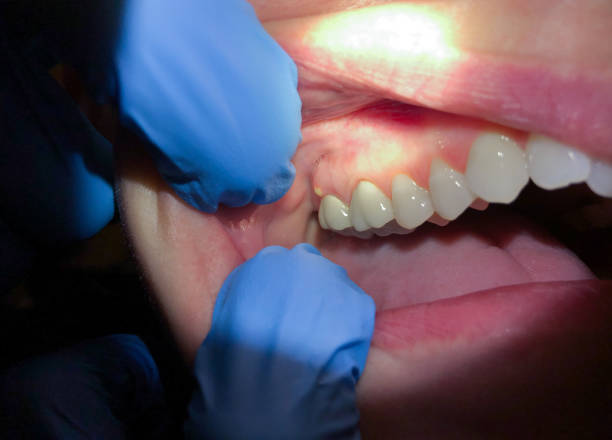 Best Emergency Tooth Extraction in Mooreville, MS